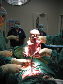 Lachlan's Birth