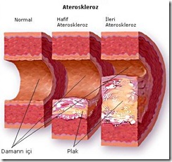 ateroskleroz