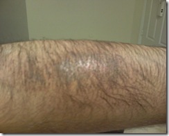 Left Arm