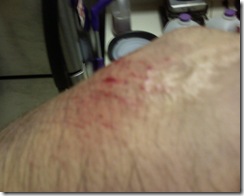 Right Elbow