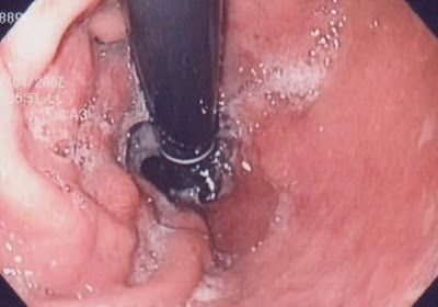 Ct+scan+abdomen+cancer