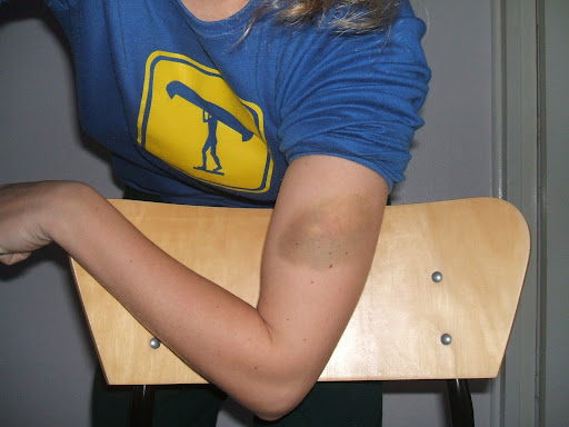 bruise