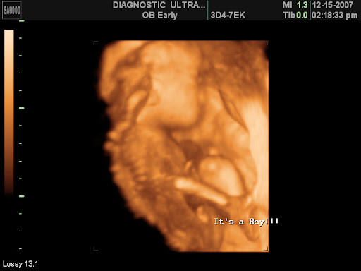 3d ultrasound 20 weeks boy. I had a 3d ultrasound.