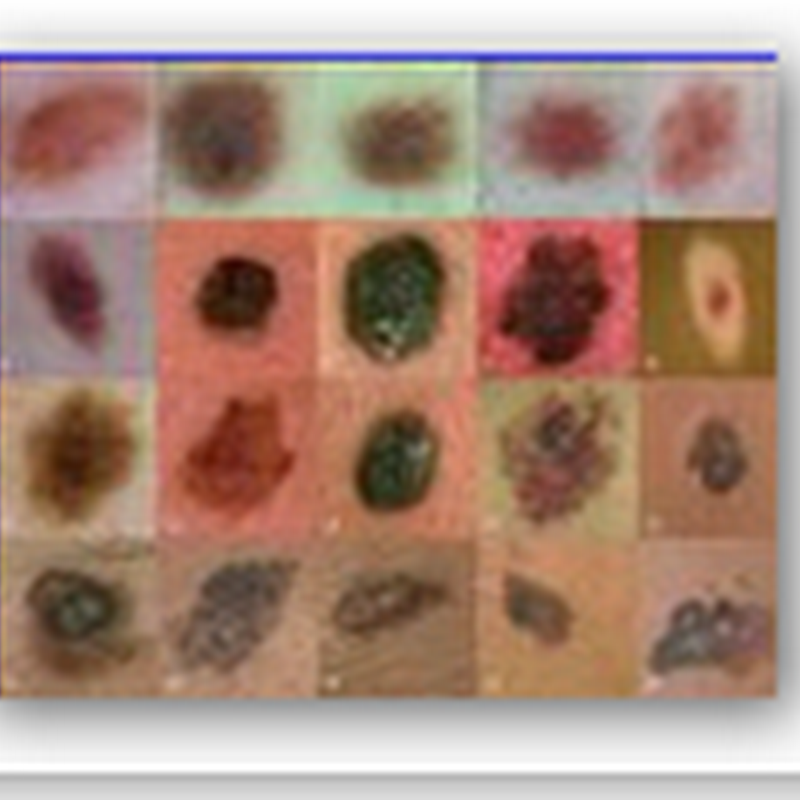 Advanced melanoma - new treatment