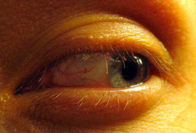 Sore eyes